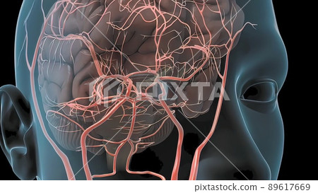 Cerebral hemorrhage as a result of an aneurysm bursting in the brain 89617669
