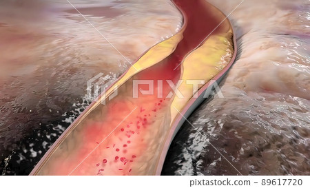 Clogging of the arteries with plaque 89617720