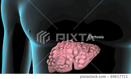 Cirrhosis is the result of long and continuous damage to the liver. Cirrhosis is the result of long and continuous damage to the liver. 89617721