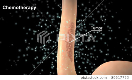 Chemotherapy is applied to the tumor areas and the tumor is cleared. 89617733