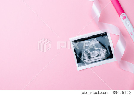 Ultrasound image pregnant baby photo. Fashion cute baby cloth with ultrasound pregnancy picture on pink background. Concept maternity, pregnancy, childbirth. Ultrasound image pregnant baby photo. Fashion cute baby cloth with ultrasound pregnancy picture on pink background. Concept maternity, pregnancy, childbirth. 89626100