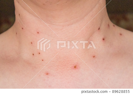 Traces on the neck of a man after cauterization of papillomas in the clinic. Traces on the neck of a man after cauterization of papillomas in the clinic. 89628855