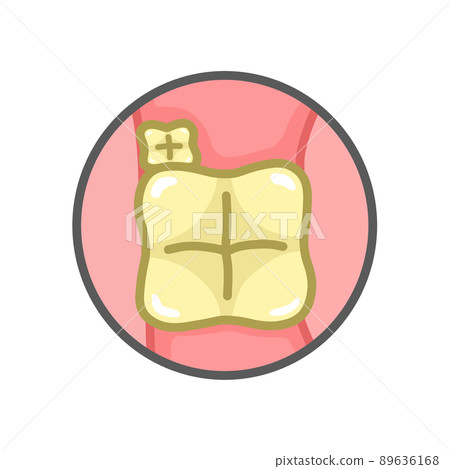 第二磨牙和第三磨牙變黃（智齒） 89636168