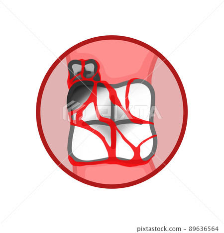 Second molars and third molars with cavities and blood (wisdom teeth) Second molars and third molars with cavities and blood (wisdom teeth) 89636564