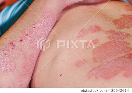 Large red inflamed scaly rash on the body of a man. Acute psoriasis in a man, severe redness on the skin, an autoimmune incurable dermatological skin disease. Red redness, spots on the skin. 89642614