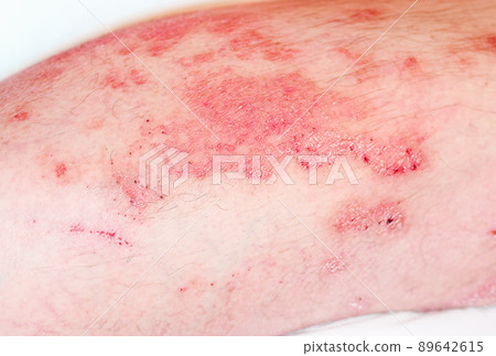 Large red,inflamed,scaly rash on man's legs.Acute psoriasis, severe reddening of the skin,an autoimmune,incurable dermatological skin disease.Red redness,spots on the skin. Large red,inflamed,scaly rash on man's legs.Acute psoriasis, severe reddening of the skin,an autoimmune,incurable dermatological skin disease.Red redness,spots on the skin. 89642615