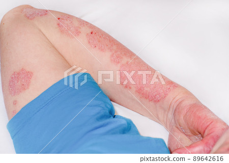 Large red inflamed scaly rash on the hands. Acute psoriasis on the arm of a man, severe redness on the skin, an autoimmune incurable dermatological skin disease. Red redness, spots on the skin. 89642616