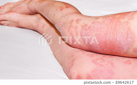 Large red,inflamed,scaly rash on man's legs.Acute psoriasis, severe reddening of the skin,an autoimmune,incurable dermatological skin disease.Joints affected by psoriatic arthritis. 89642617