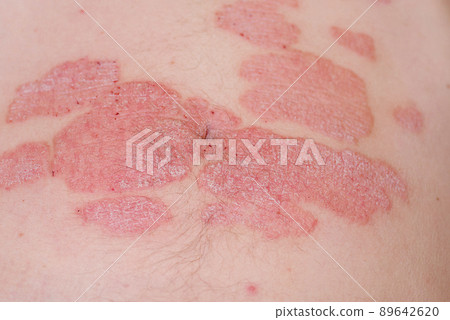 Red redness, spots on the skin.Large red inflamed scaly rash on the stomach. Acute psoriasis on the stomach in a man, severe redness on the skin, an autoimmune incurable dermatological skin disease. 89642620