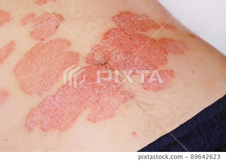 Large red inflamed scaly rash on the stomach. Acute psoriasis on the stomach in a man, severe redness on the skin, an autoimmune incurable dermatological skin disease. Red redness, spots on the skin. Large red inflamed scaly rash on the stomach. Acute psoriasis on the stomach in a man, severe redness on the skin, an autoimmune incurable dermatological skin disease. Red redness, spots on the skin. 89642623