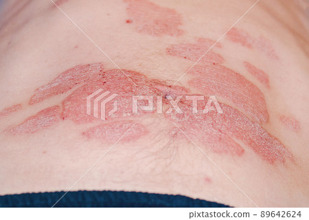 Red redness, spots on the skin.Large red inflamed scaly rash on the stomach. Acute psoriasis on the stomach in a man, severe redness on the skin, an autoimmune incurable dermatological skin disease. Red redness, spots on the skin.Large red inflamed scaly rash on the stomach. Acute psoriasis on the stomach in a man, severe redness on the skin, an autoimmune incurable dermatological skin disease. 89642624