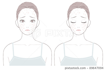 患有紅色痤瘡疤痕的女人 89647094