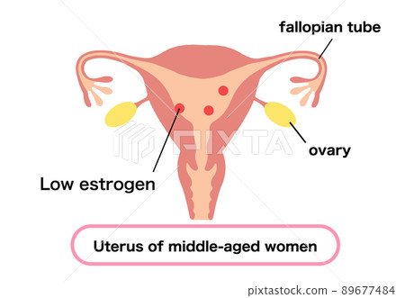 雌激素低的中年婦女子宮示意圖 雌激素低的中年婦女子宮示意圖 89677484