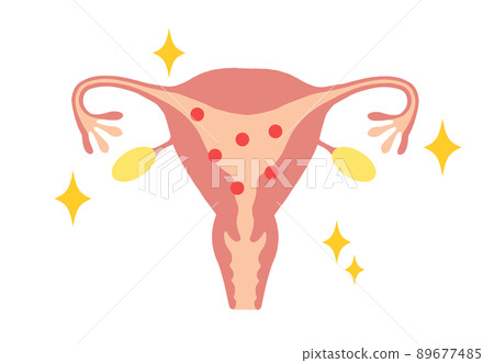 一個年輕女子的子宮中含有大量雌激素的插圖 一個年輕女子的子宮中含有大量雌激素的插圖 89677485