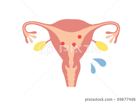 雌激素低的中年婦女子宮示意圖 雌激素低的中年婦女子宮示意圖 89677486