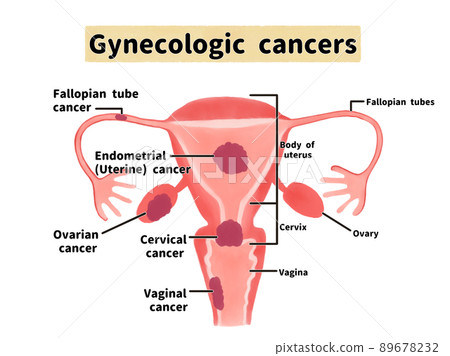 Illustrated illustrations of gynecological cancer types English 89678232