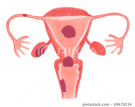 Illustrated illustration of gynecological cancer types without letters Illustrated illustration of gynecological cancer types without letters 89678234