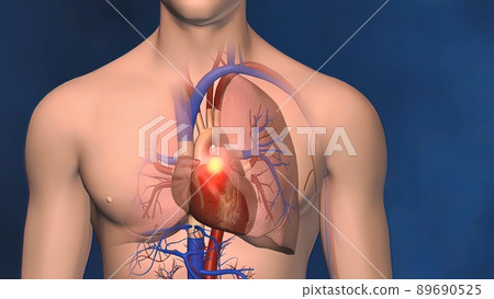 Blood clot in the leg hitting the heart Blood clot in the leg hitting the heart 89690525