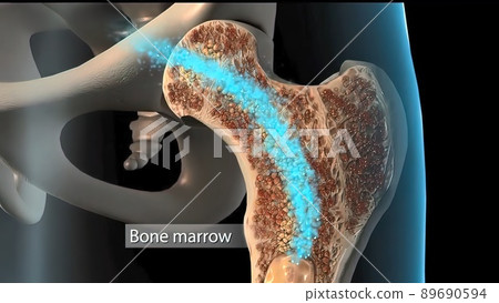 Development of human bone osteoporosis spongy tissue from normal to sick Development of human bone osteoporosis spongy tissue from normal to sick 89690594