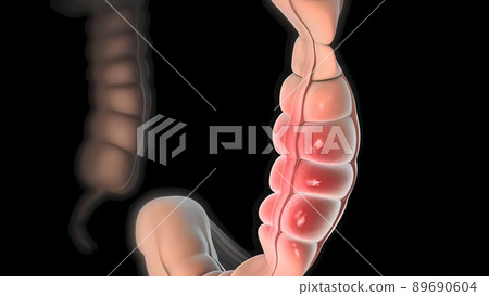 Magnifying glass of intestinal cancer. Tumor formation and growth 89690604