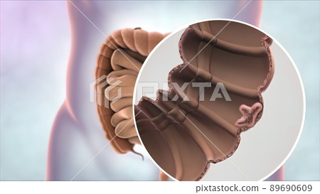 Magnifying glass of intestinal cancer. Tumor formation and growth 89690609