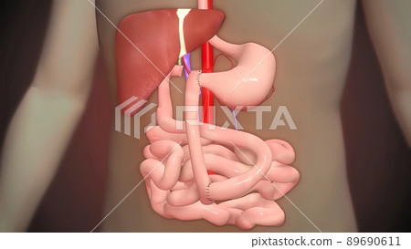 Surgery to remove any part of the intestine, bowel resection Surgery to remove any part of the intestine, bowel resection 89690611