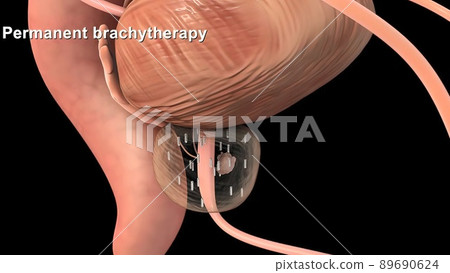 Medically accurate 3d illustration of prostate cancer 89690624
