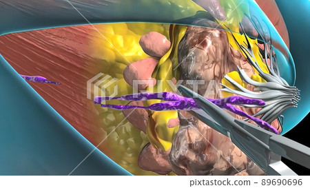 Surgery for a growing breast tumor. 89690696