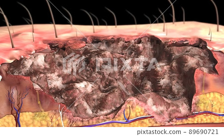 First Degree Burn epidermis 3d First Degree Burn epidermis 3d 89690721