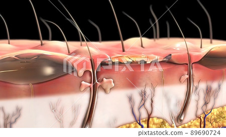 Serious burns on human skin Serious burns on human skin 89690724