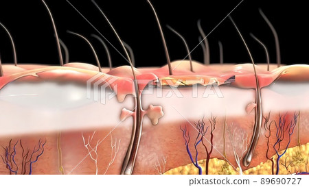 Serious burns on human skin 89690727