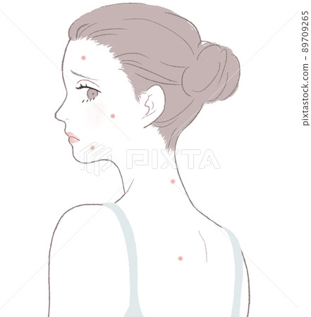 Women suffering from acne Women suffering from acne 89709265