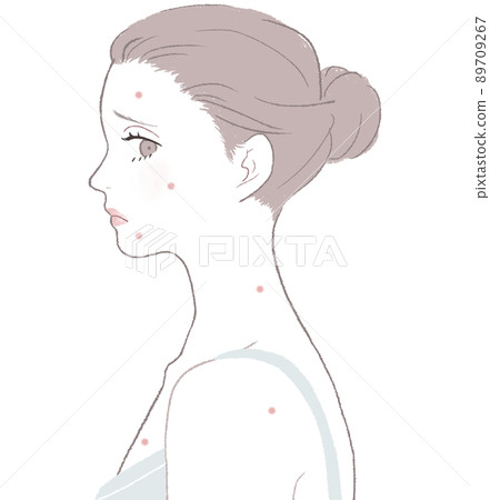 Women suffering from acne Women suffering from acne 89709267