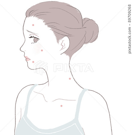 Women suffering from acne Women suffering from acne 89709268