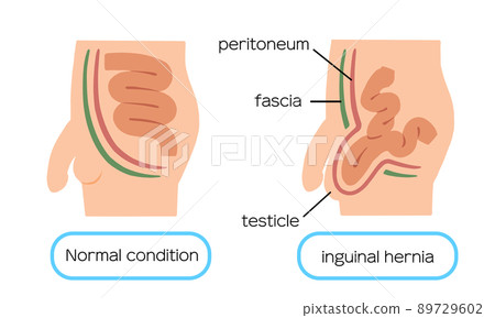 腹股溝疝的插圖 89729602