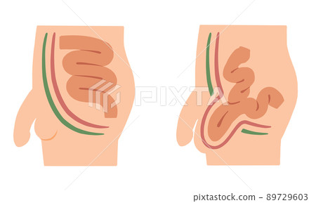 腹股溝疝的插圖 89729603
