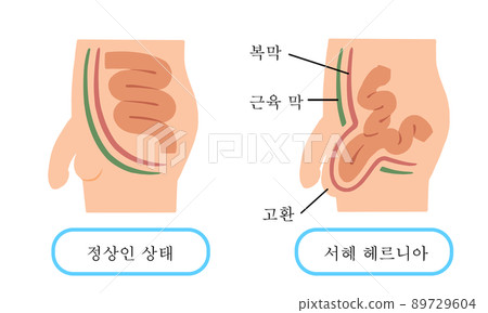 Inguinal hernia illustration of inguinal hernia 89729604