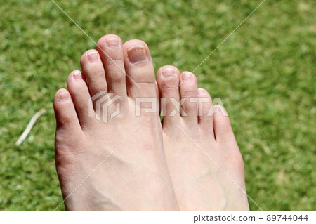 Women's bare feet on the lawn. Chilblains, after rough nails 89744044