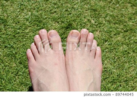 Women's bare feet on the lawn. Chilblains, after rough nails 89744045