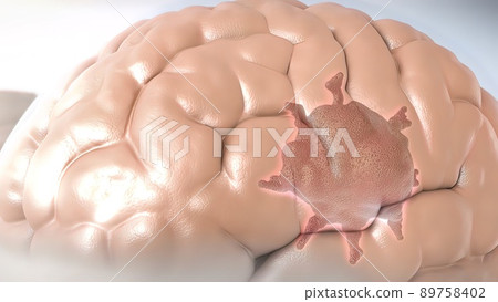 A malignant tumor of the glial tissue of the nervous system. A malignant tumor of the glial tissue of the nervous system. 89758402