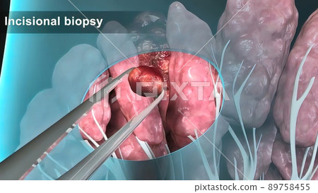 Breast cancer Girl with breast pathology. . Illustration and close-up of female human structure. 89758455