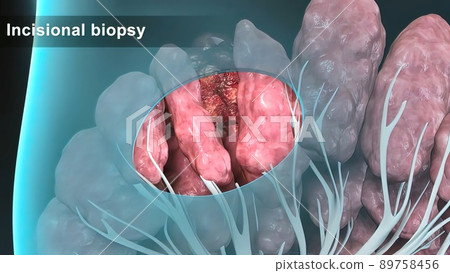 Breast cancer Girl with breast pathology. . Illustration and close-up of female human structure. Breast cancer Girl with breast pathology. . Illustration and close-up of female human structure. 89758456