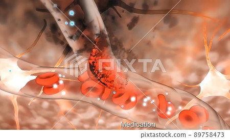 Brain Hemorrhagic Stroke Due To Aneurysm Rupture. Brain Hemorrhagic Stroke Due To Aneurysm Rupture. 89758473