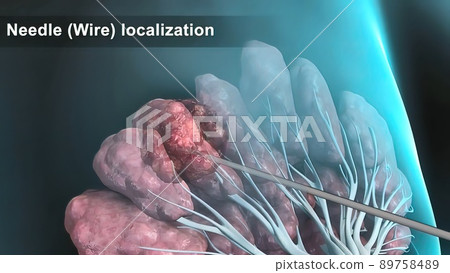 Breast cancer Girl with breast pathology. . Illustration and close-up of female human structure. Breast cancer Girl with breast pathology. . Illustration and close-up of female human structure. 89758489