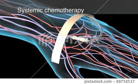 Chemotherapy is applied to the tumor areas and the tumor is cleared. 89758537