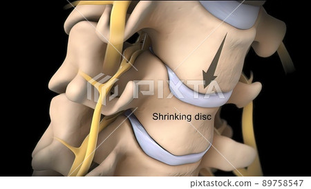Central disc protrusion top view Central disc protrusion top view 89758547
