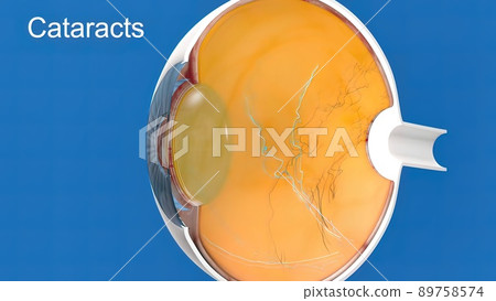 Cataract, clouding of the lens of the eye that causes decreased vision. Cataract, clouding of the lens of the eye that causes decreased vision. 89758574