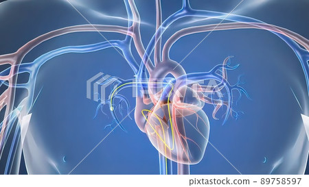 Opening the occluded artery by inserting a stent Opening the occluded artery by inserting a stent 89758597