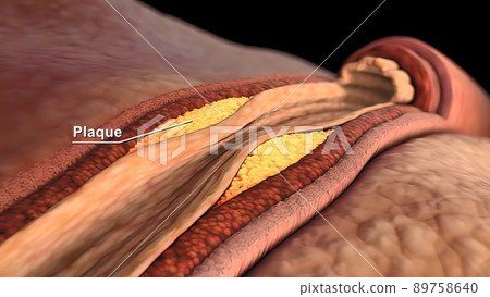 Coronary artery spasm is a brief, sudden narrowing of one of these arteries. 89758640