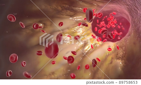 Clogging of the arteries with plaque Clogging of the arteries with plaque 89758653
